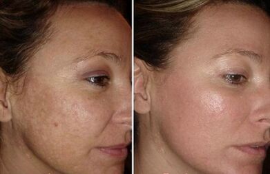 Laser Gesiichts Haut Rejuvenation virun an no Fotoen
